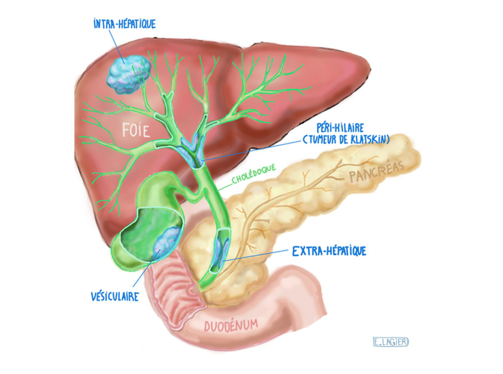 Cholangiocarcinome AFEF